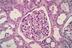 Peut-on diagnostiquer la néphropathie lupique de manière non invasive ?